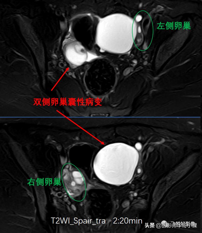 [飞利浦磁共振技术]磁共振扫描下的“女性输卵管成像”，看视频吧