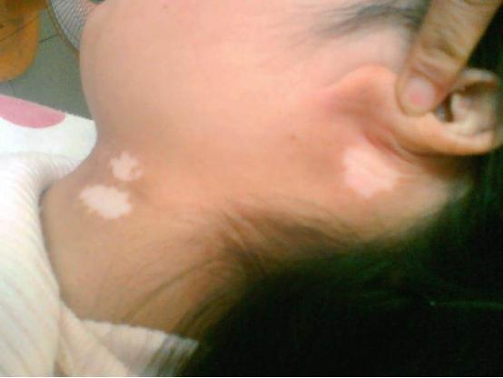 脖子上的白斑怎么治,脖子上白斑是怎么治