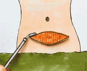 剖宫产如何才能让伤口愈合不留疤,剖宫产一年后的疤痕图片