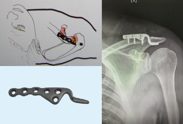 肩锁关节脱位复位视频,肩锁关节脱位固定带