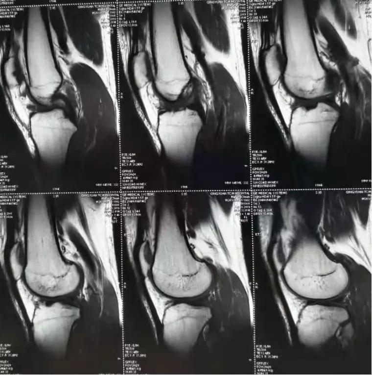 滑雪运动前叉韧带损伤康复,滑雪导致前交叉韧带断裂