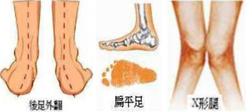 孩子足外翻通过训练可以痊愈吗,孩子轻微足外翻怎么办