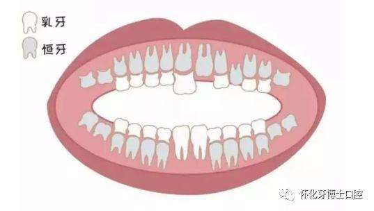 乳牙坏了不用管有恒牙代替对吗,乳牙坏啦不补牙会影响恒牙吗