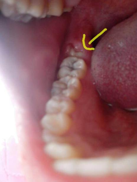 智齿冠周炎治疗方法的全过程,智齿不能萌出导致牙龈肿痛怎么办