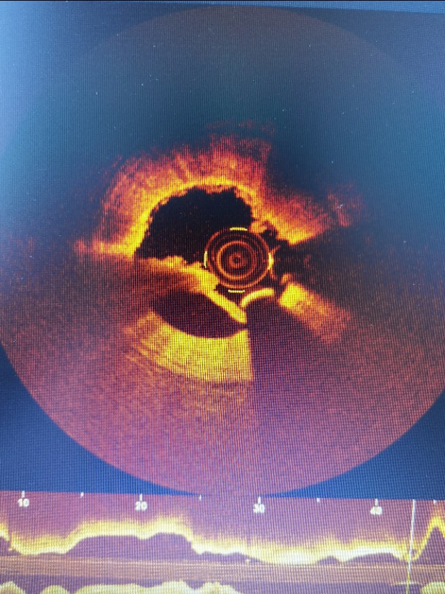 信阳市中心医院心脏射频消融手术,信阳中心医院心血管科室怎样