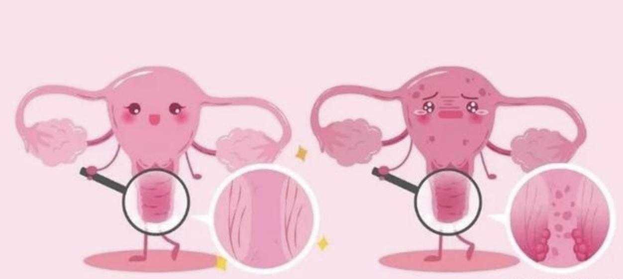 堪称女性杀手的宫颈癌,我要不要打HPV疫苗预防