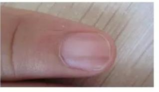 指甲问题对应身体哪里有问题,指甲的各种病变及解决办法