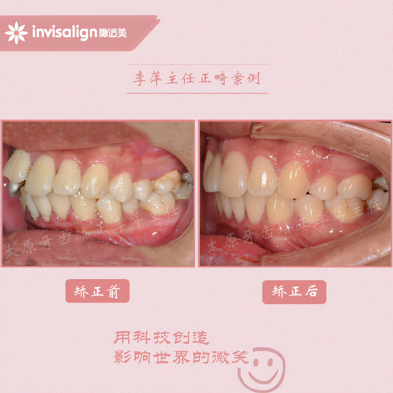 重度牙齿拥挤矫正经历,太原矫正牙齿需要多久