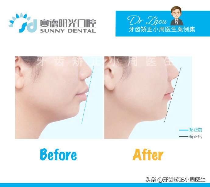 下巴后缩整容玻尿酸还是假体,如何不靠整容改变下巴