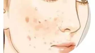 痘印反反复复怎么办,痘印一直反反复复怎么办