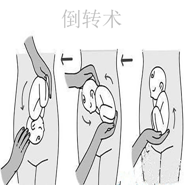 33周头位应该不会再变了吧,33周头位还会转胎位吗