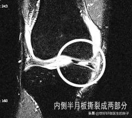 怎样能看懂膝关节核磁图片,如何看懂膝关节磁共振报告