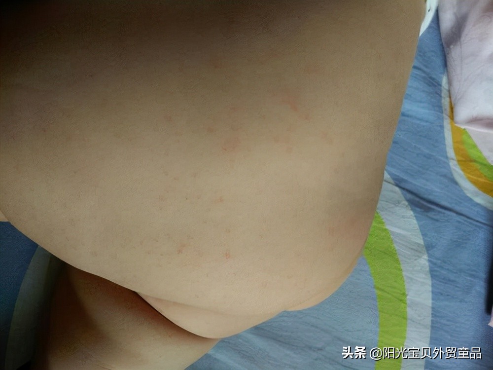 春夏交替湿疹高发季做好这几点,湿疹高发期如何护理谨记4大原则