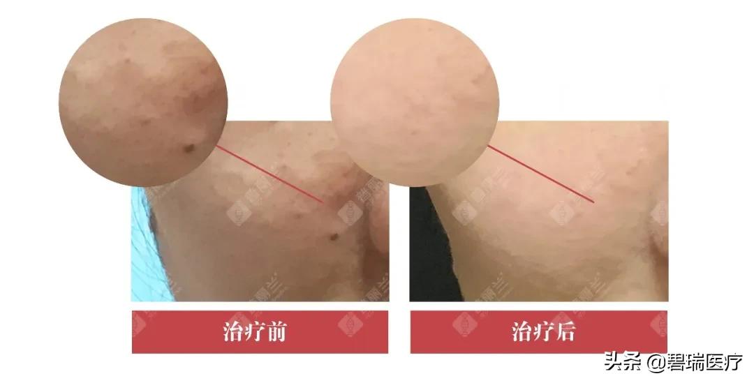 普丽兰pdrn再生2.0,普丽兰pdrn三重作用