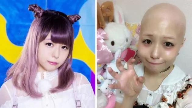 日本15岁脱毛症状,日本脱毛症