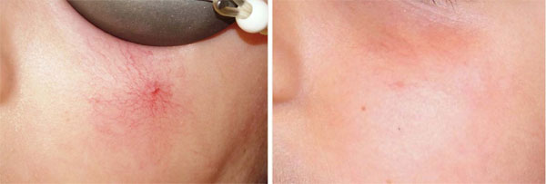 身上长这种红痣小心慢性肝损伤,身上有血痣一定是肝出现问题了吗