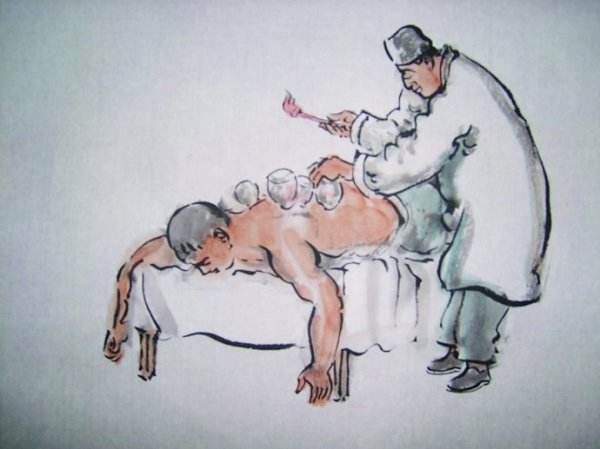 拔罐的知识你知道多少