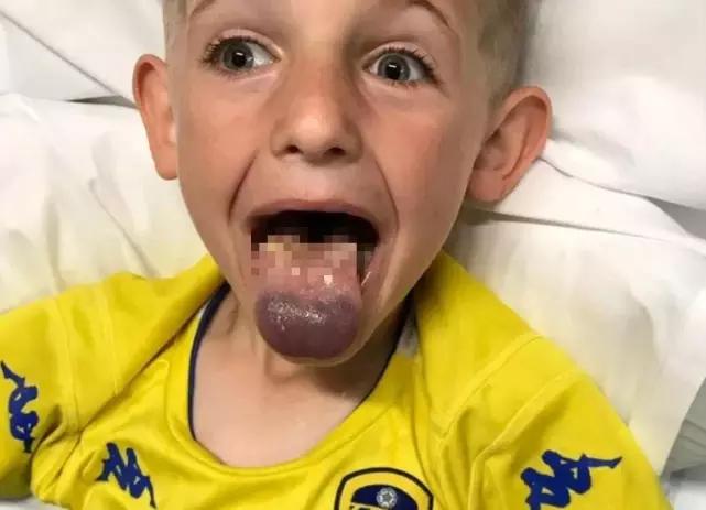 孩子舌头被饮料瓶困住,小孩喝水舌头被卡杯盖