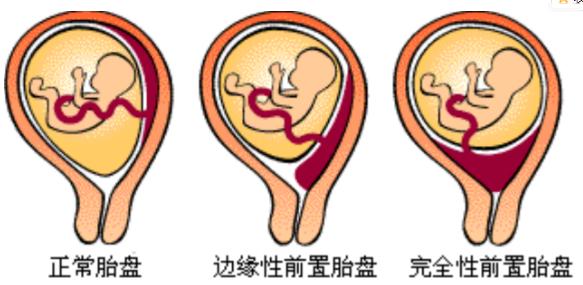 单绒双羊37周需要提前住院待产吗,孕妇最多可以提前多少天住院待产