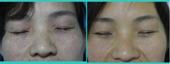 女人眼睛周围长疙瘩图片,女人眼睛周围长疙瘩是怎么回事