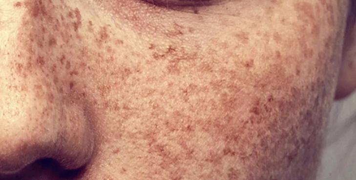 长斑了要怎么调理呢,长斑了该怎么办该用什么护肤品