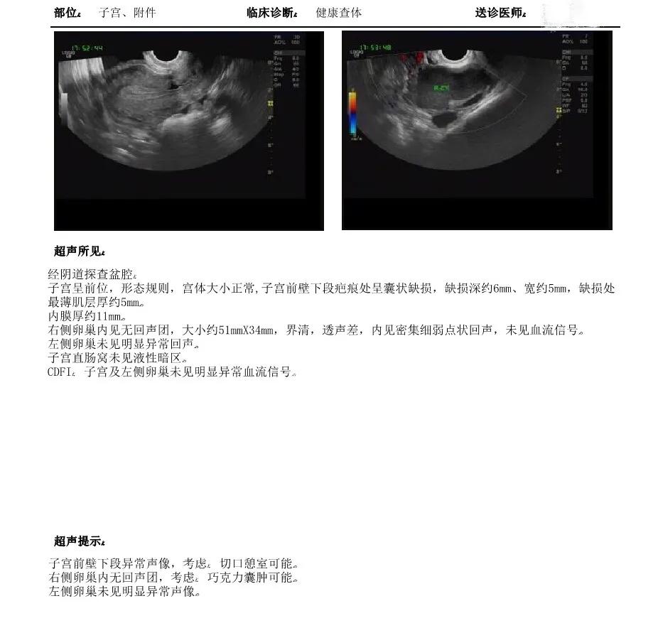 巧克力囊肿的诊断与治疗,巧克力囊肿误诊手术了怎么办