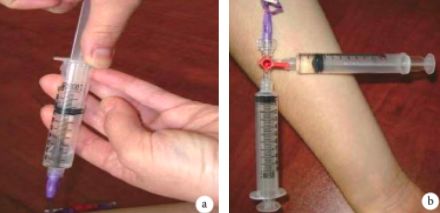 中心静脉导管抽回血的正确方法,静脉抽不出来血怎么办