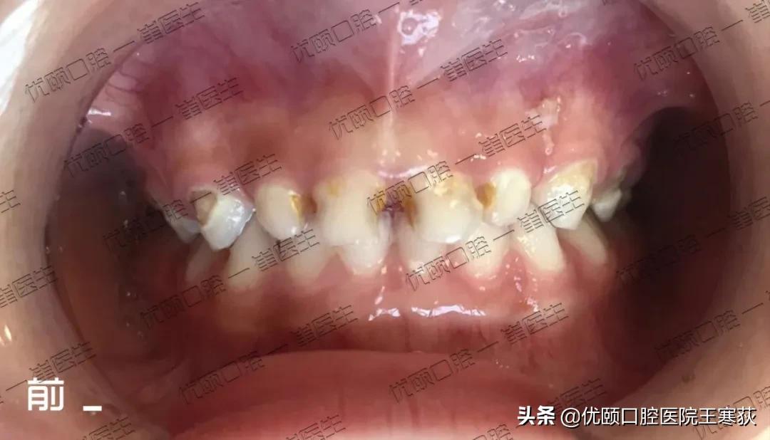 儿童全麻治疗过程,三岁宝宝根管治疗全麻有危害吗