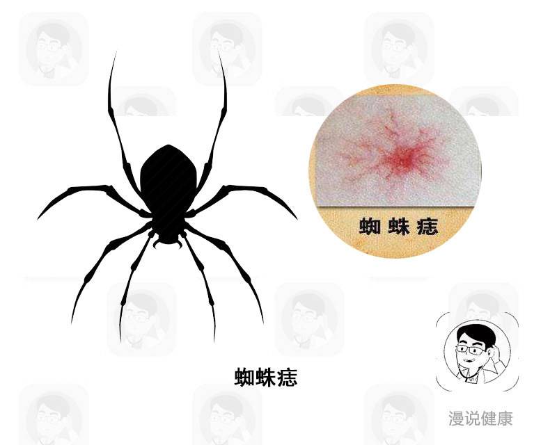 脸上长痣是癌细胞吗,皮肤上长出这3种痣千万别用手抠