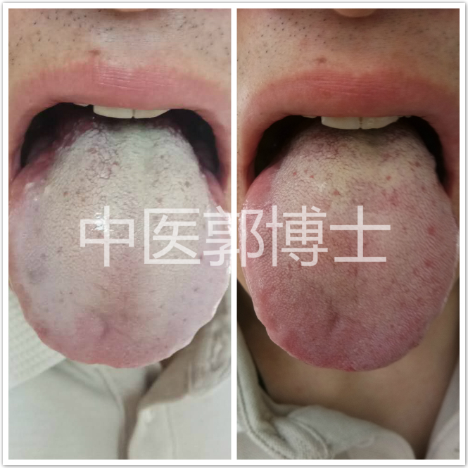 抑郁症吃中药后十天反而更严重了,抑郁症中药治疗几天见效果