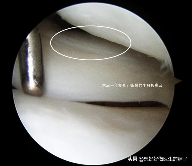 膝盖半月板撕裂还可以跑步吗,半月板撕裂未触及关节面能自愈吗