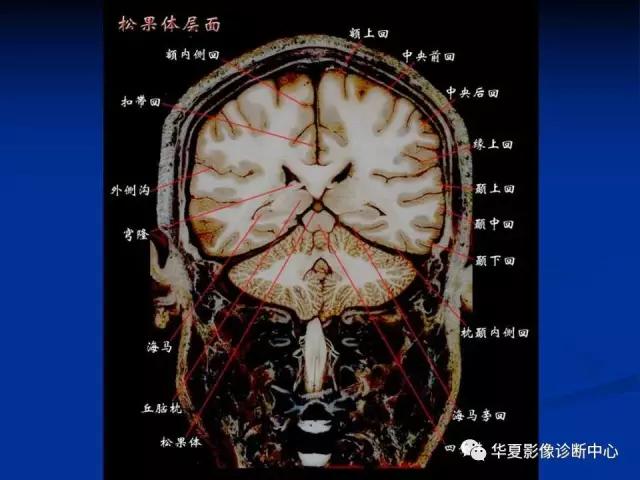 电子版头颅ct与mri断层解剖,头颅mri血管解剖与分段详解