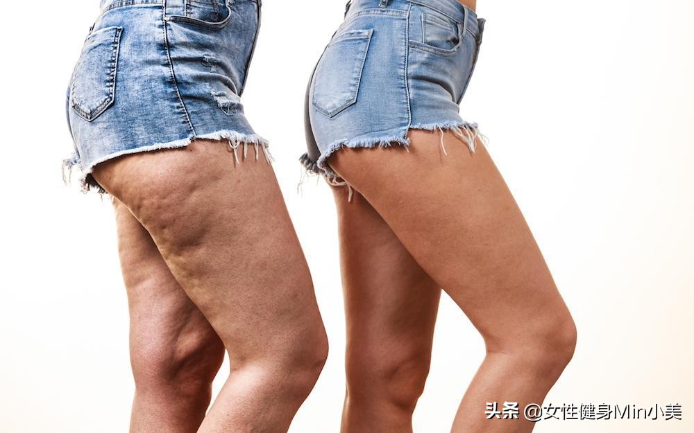 大腿后侧橘皮组织明显怎么办,怎样去掉臀部和大腿后部的橘皮