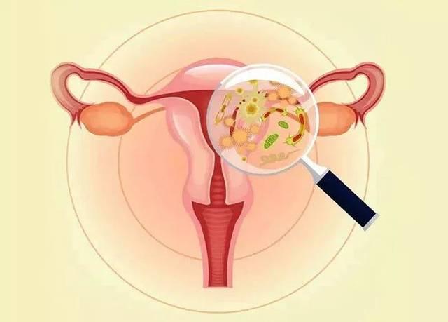 阴道炎引起早产,阴道炎会引起孕妇胎膜早破吗