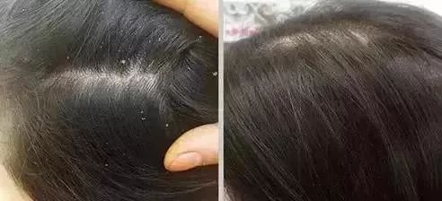 清爽头皮不掉发洗发露,秃头油腻头屑多洗发水推荐