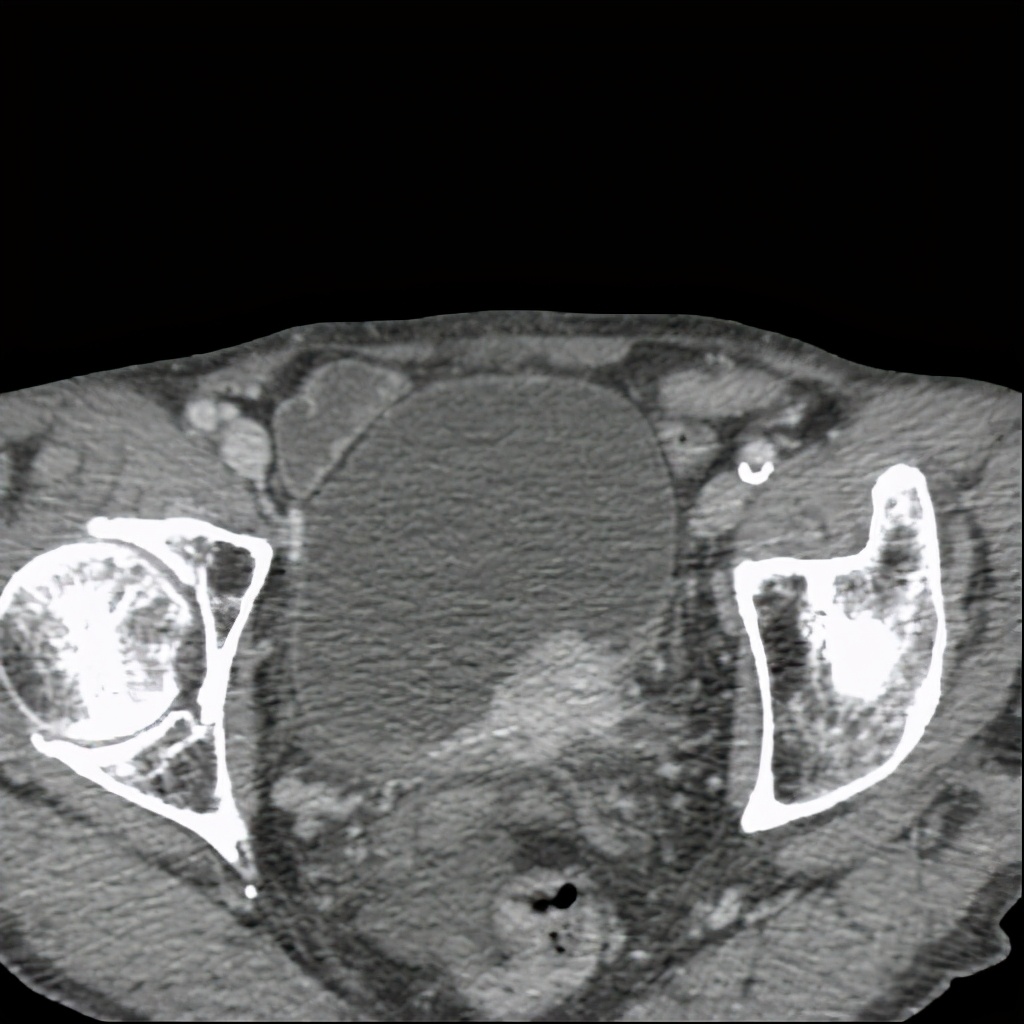 尿路造影输尿管间断显影,静脉尿路造影和排泄性尿路造影