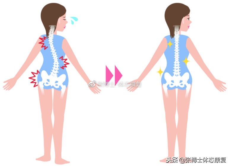 关于脊柱侧弯的原因,脊柱侧弯的介绍