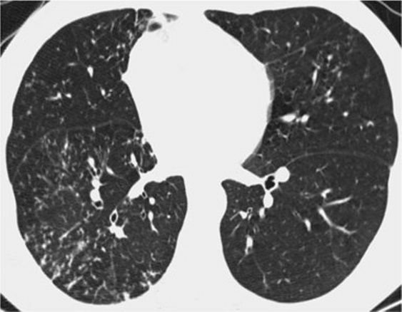 间质性肺疾病看病经验分享,分享肺腺癌临床实验的例子