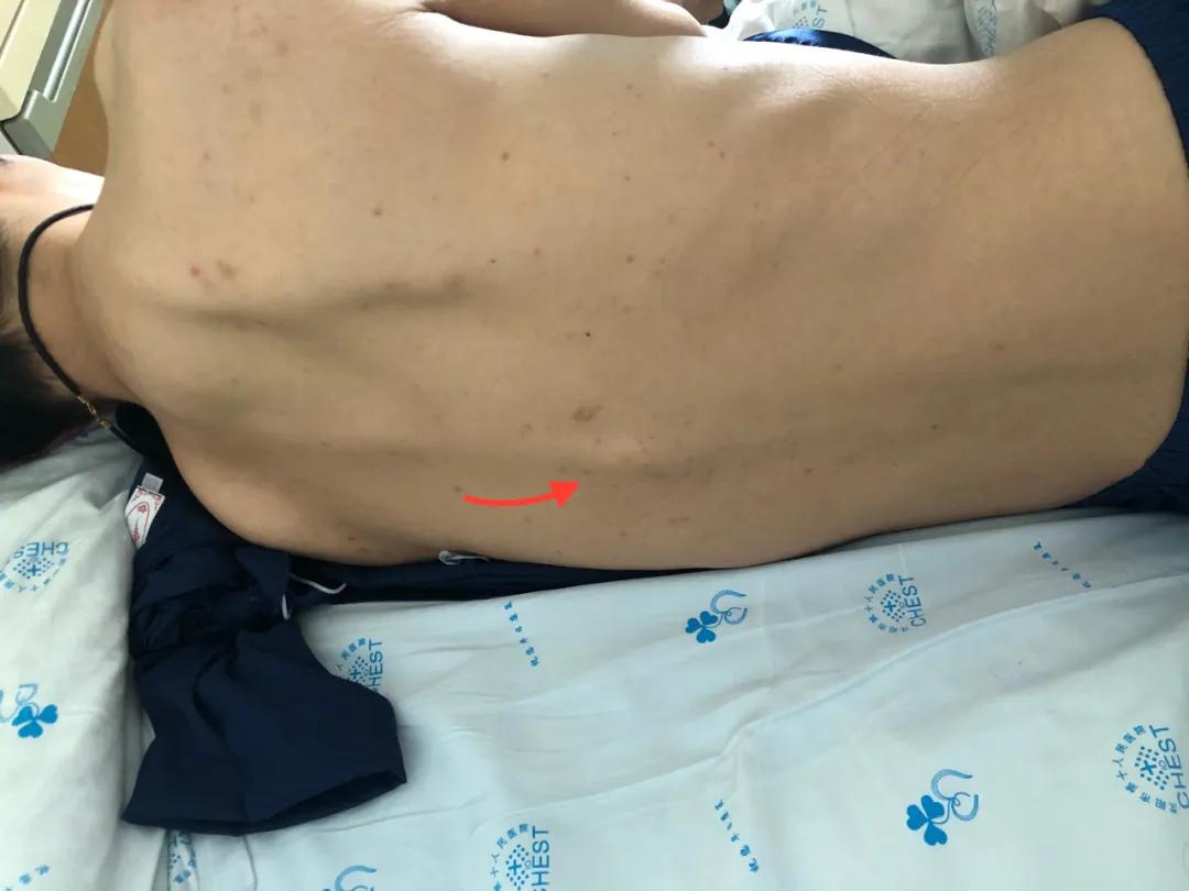 腰椎结核会引起哪些症状,久坐腰疼是腰椎结核么