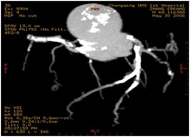 冠脉ct造影,冠脉ct检查轻微狭窄还用做造影吗