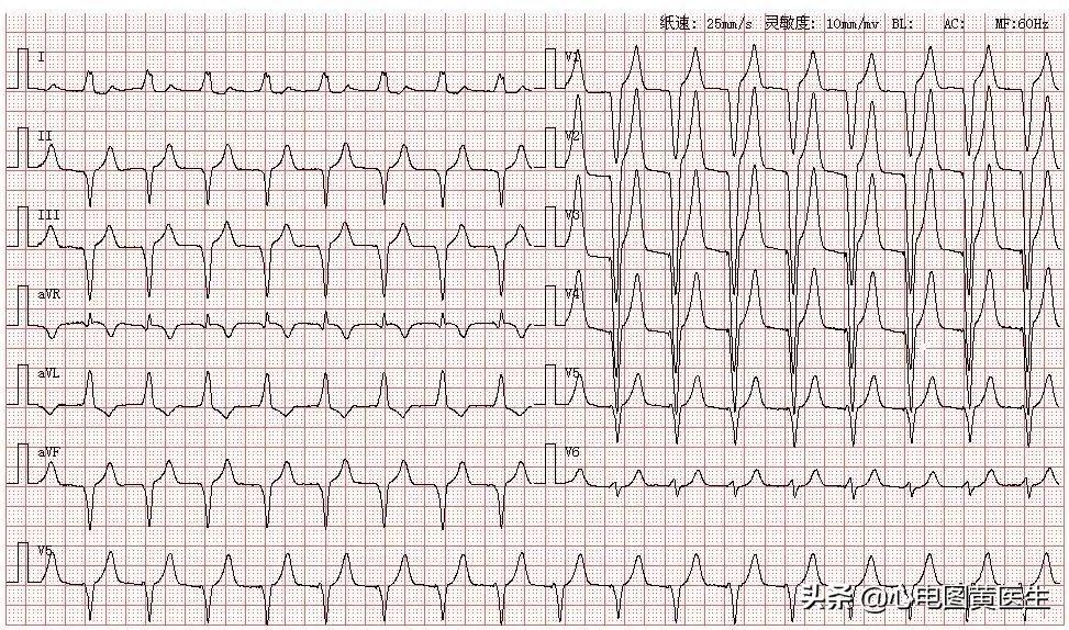 一度房室传导阻滞可以剧烈运动吗,一度房室传导阻滞是心脏病吗