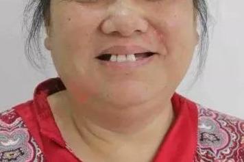 缺牙戴活动假牙40年有什么变化,上牙戴活动假牙的亲身经历