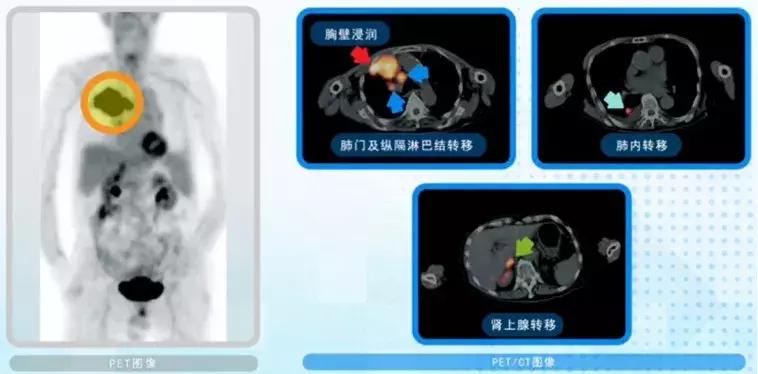 外国早期筛查癌症,petct用于诊断癌症