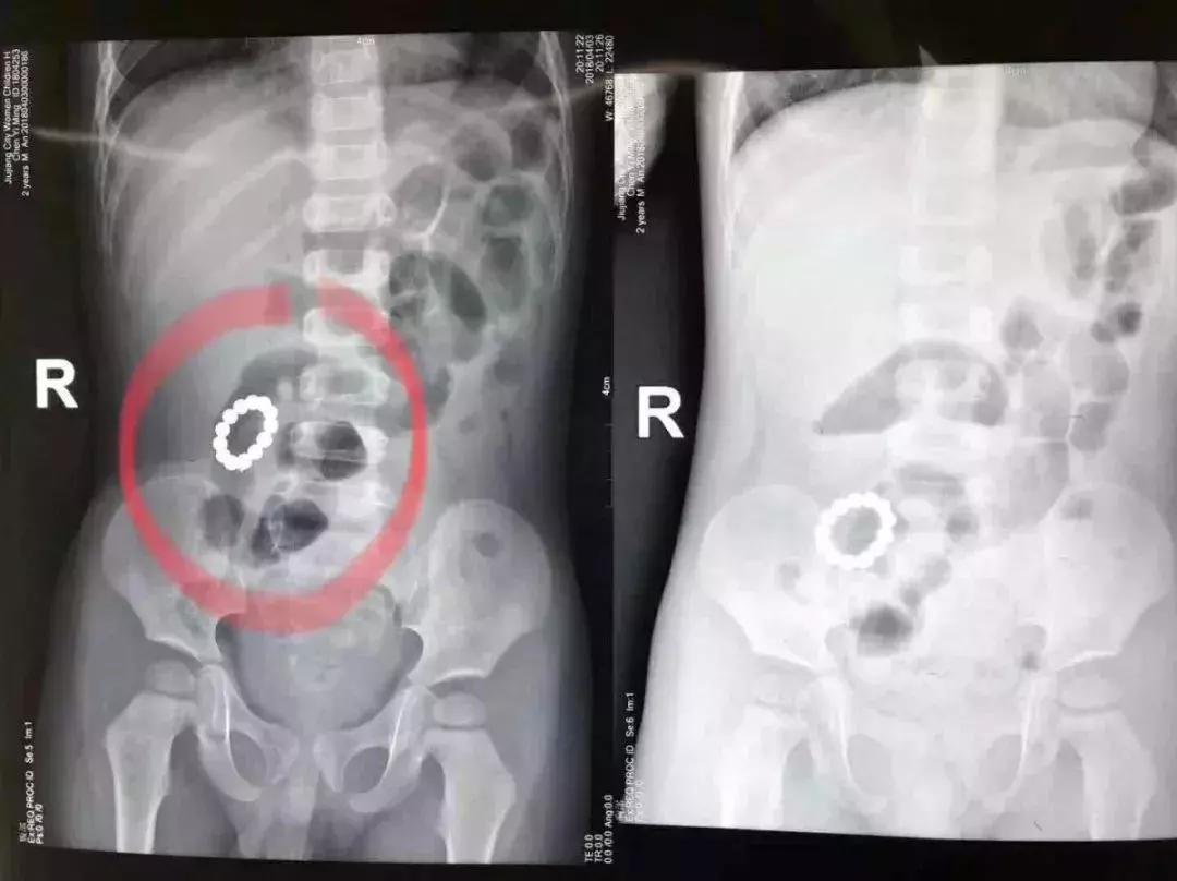 2岁孩子误吞了个小勺子,2岁宝宝误吞枣核第二天没拉出来