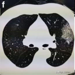 新型冠状病毒感染的肺炎患者肺部影像学改变