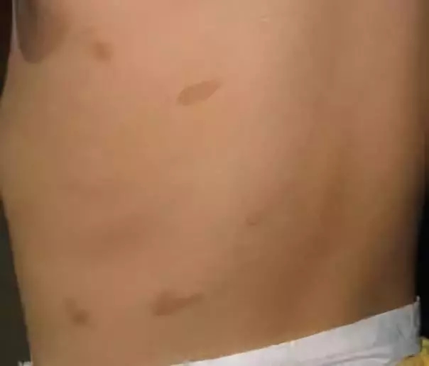 宝宝身上胎记很多是怎么回事,宝宝身上胎记多是什么原因引起的