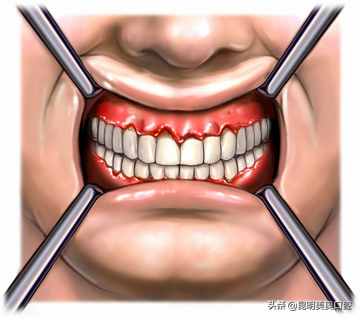 牙龈萎缩导致牙齿脱落怎么办,牙龈萎缩牙齿脱落如何治疗