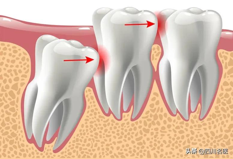 智齿一次拔几颗合适,智齿一定要拔吗几岁拔