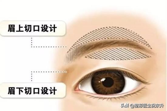 眼皮下垂做全切好还是做提眉好呢,做完提眉两年以后眼皮还会下垂吗