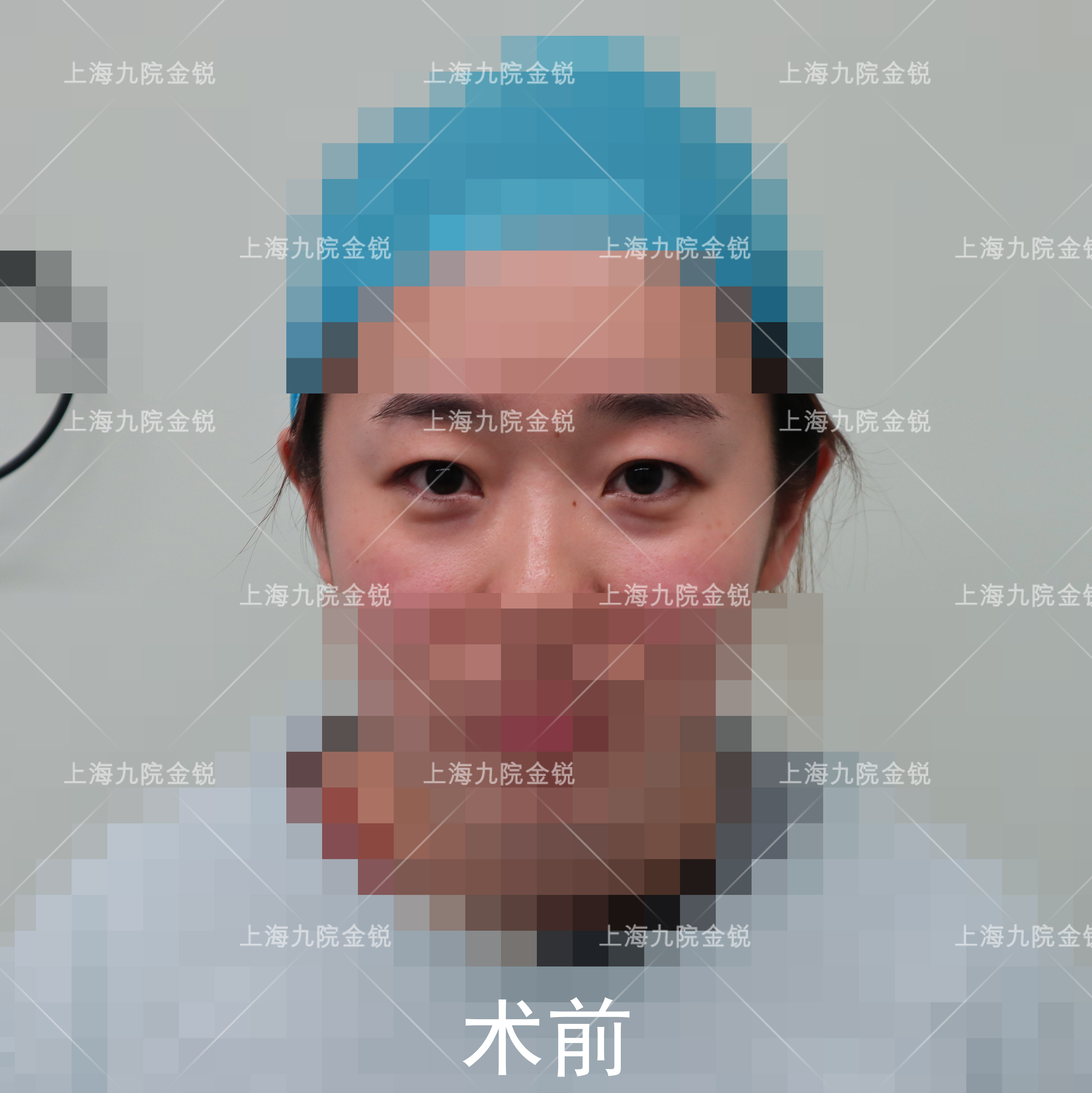 眶隔释放去眼袋为何如此受青睐？原因原来不仅仅是这样